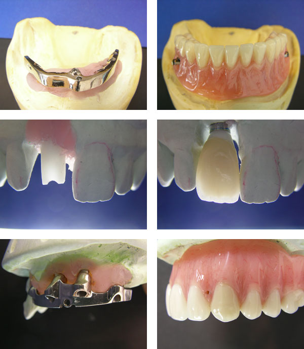 Dental Implant Restorations: Before and After
