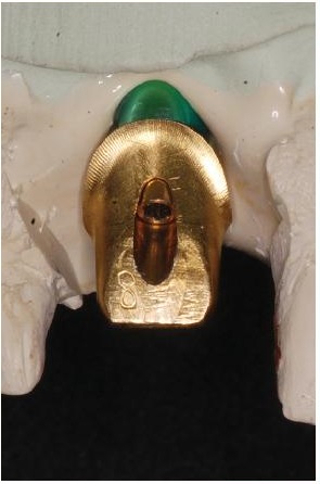 implant custom gold