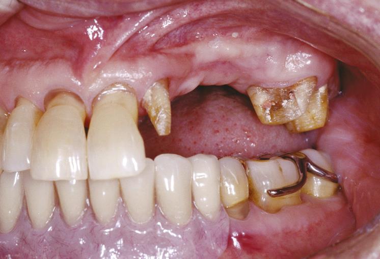 Dental implant restorations 10 years update 1