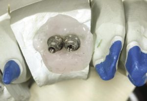 Dental implant restorations 10 years update 2