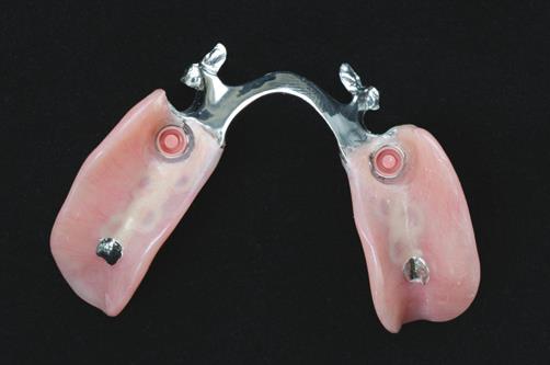 Implant Stabilized Cast Partials​ 2