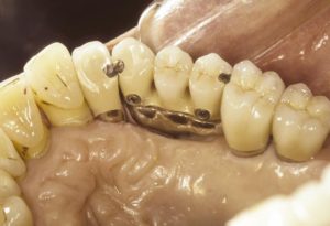 Dental implant restorations10 years update 6