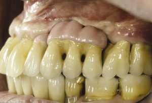 Dental implant restorations 10 years update 5