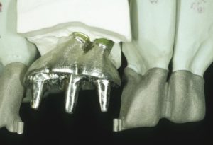 implant 10 years update 3