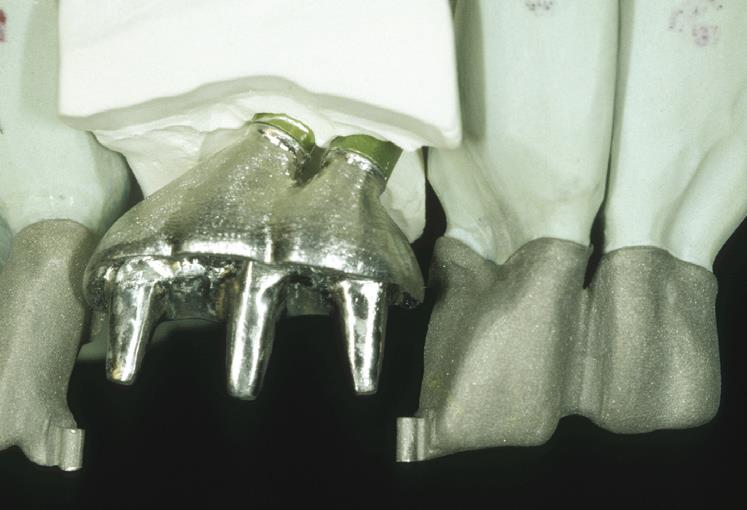 Dental implant restorations 10 years update 3