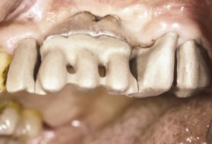 Dental implant restorations 10 years update 4