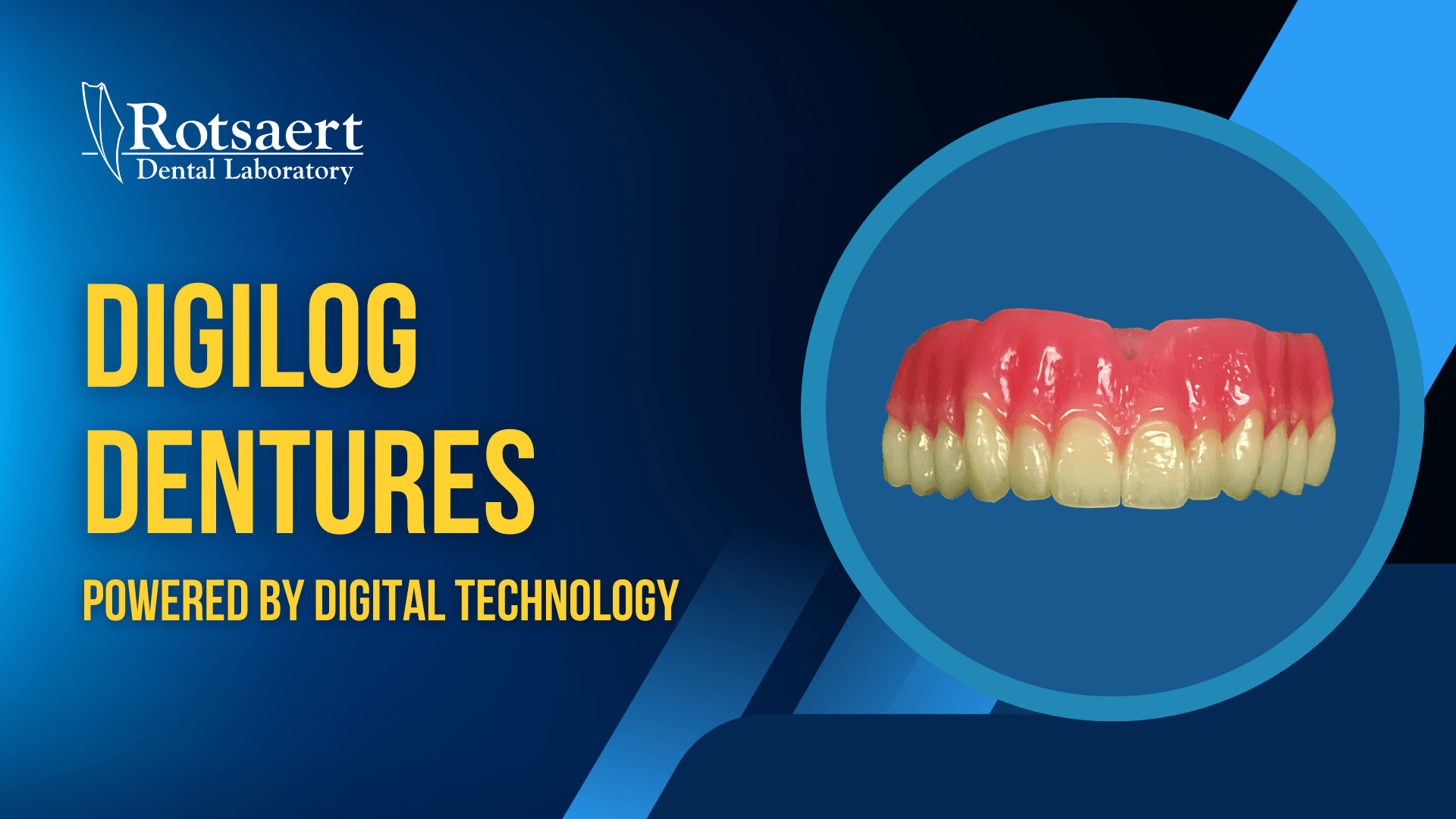 Digilog Dentures | Rotsaert Dental Laboratory